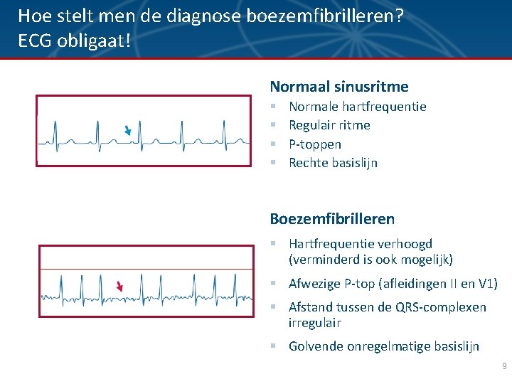 Hoe stelt men de diagnose boezemfibrilleren? ECG obligaat! Normaal sinusritme § § Normale hartfrequentie