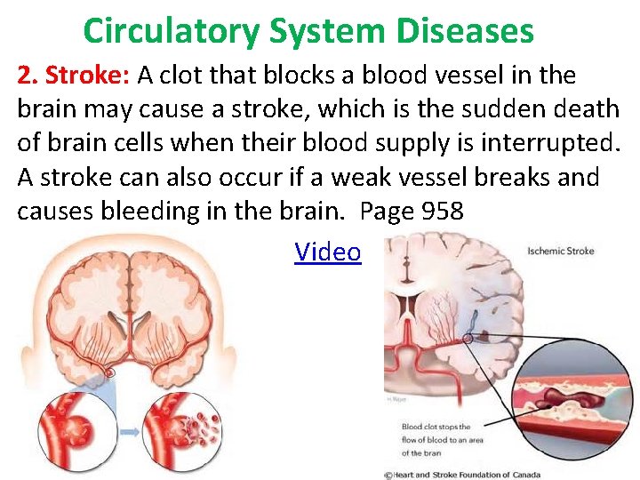 Circulatory System Diseases 2. Stroke: A clot that blocks a blood vessel in the