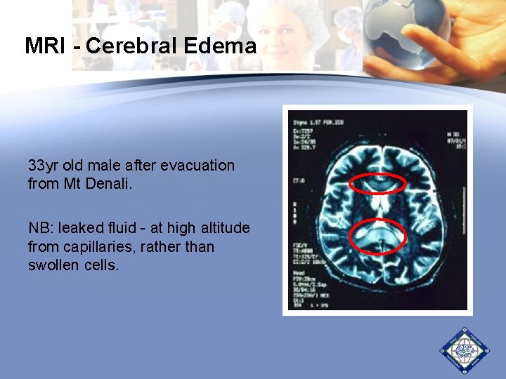 MRI - Cerebral Edema 33 yr old male after evacuation from Mt Denali. NB: