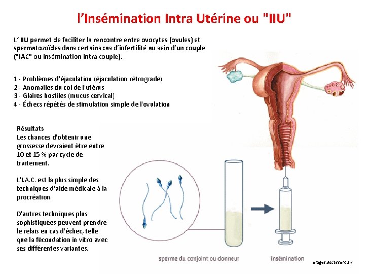 l’Insémination Intra Utérine ou "IIU" L‘ IIU permet de faciliter la rencontre entre ovocytes