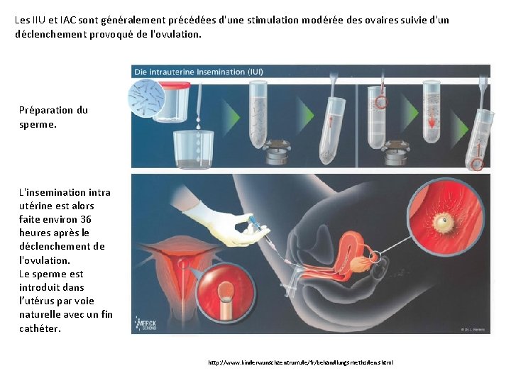 Les IIU et IAC sont généralement précédées d'une stimulation modérée des ovaires suivie d'un