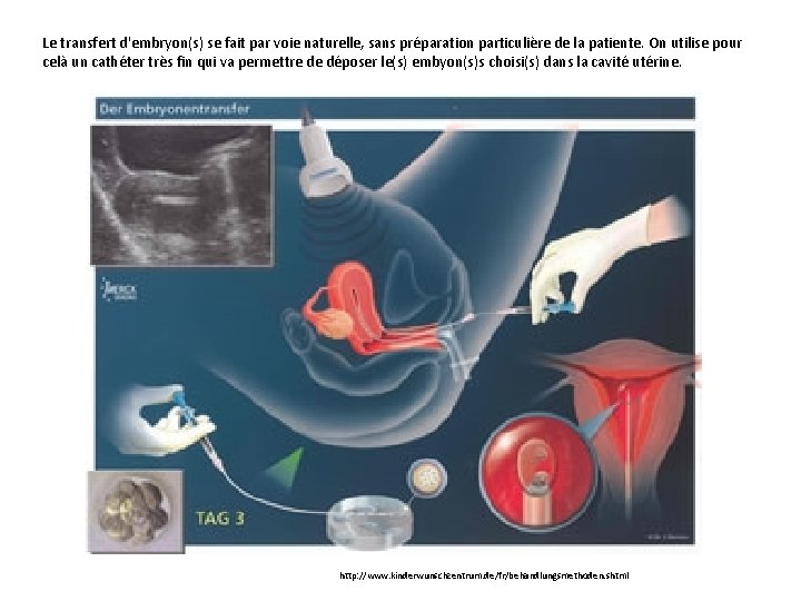 Le transfert d'embryon(s) se fait par voie naturelle, sans préparation particulière de la patiente.
