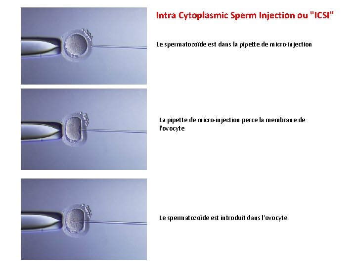 Intra Cytoplasmic Sperm Injection ou "ICSI" Le spermatozoïde est dans la pipette de micro-injection