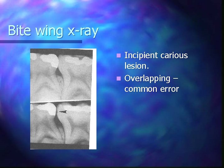 Bite wing x-ray Incipient carious lesion. n Overlapping – common error n 