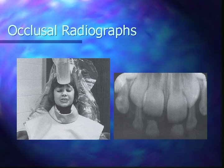 Occlusal Radiographs 