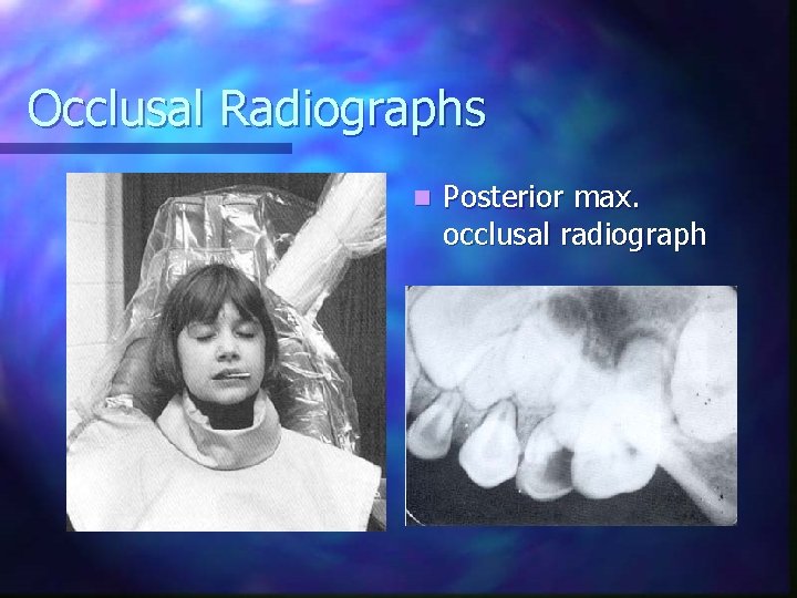 Occlusal Radiographs n Posterior max. occlusal radiograph 