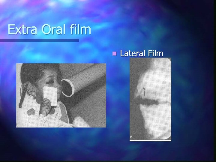 Extra Oral film n Lateral Film 