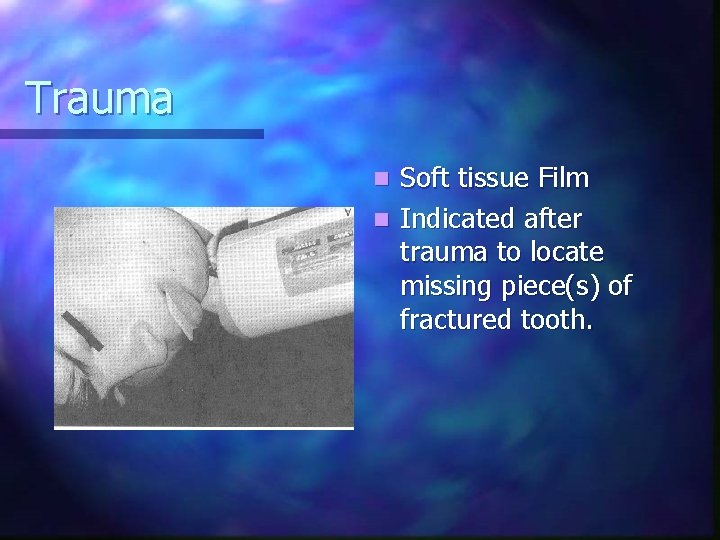 Trauma Soft tissue Film n Indicated after trauma to locate missing piece(s) of fractured