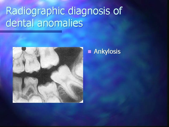 Radiographic diagnosis of dental anomalies n Ankylosis 