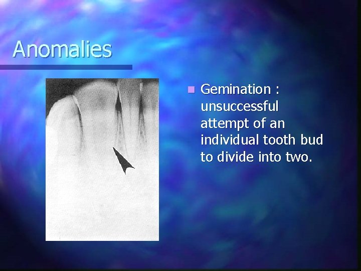 Anomalies n Gemination : unsuccessful attempt of an individual tooth bud to divide into