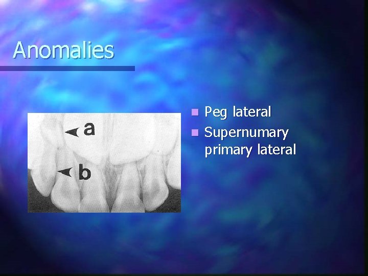 Anomalies Peg lateral n Supernumary primary lateral n 