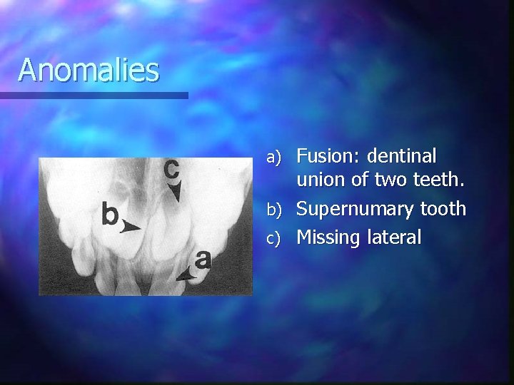 Anomalies Fusion: dentinal union of two teeth. b) Supernumary tooth c) Missing lateral a)