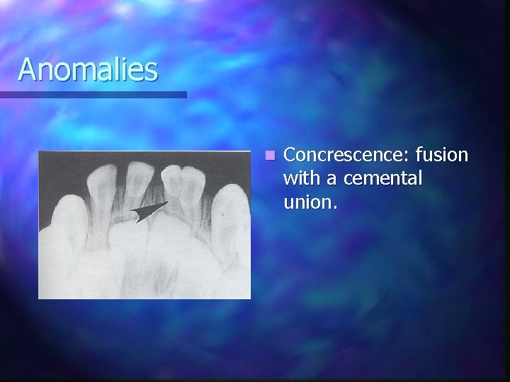 Anomalies n Concrescence: fusion with a cemental union. 