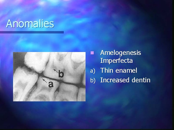 Anomalies Amelogenesis Imperfecta a) Thin enamel b) Increased dentin n 