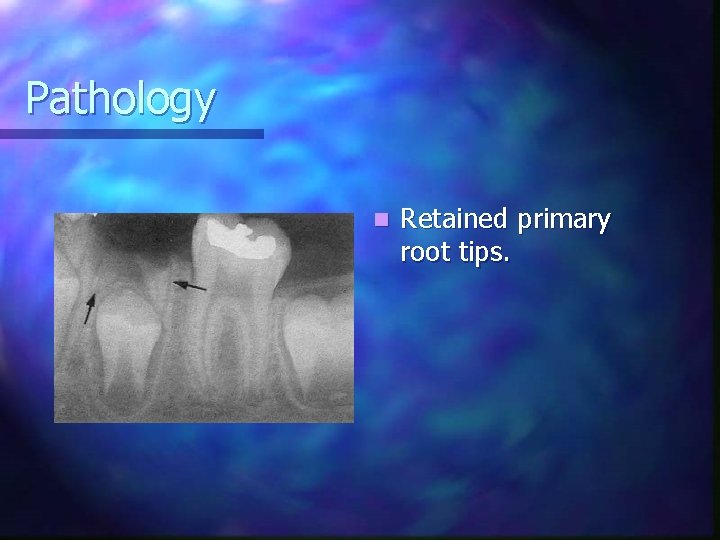 Pathology n Retained primary root tips. 