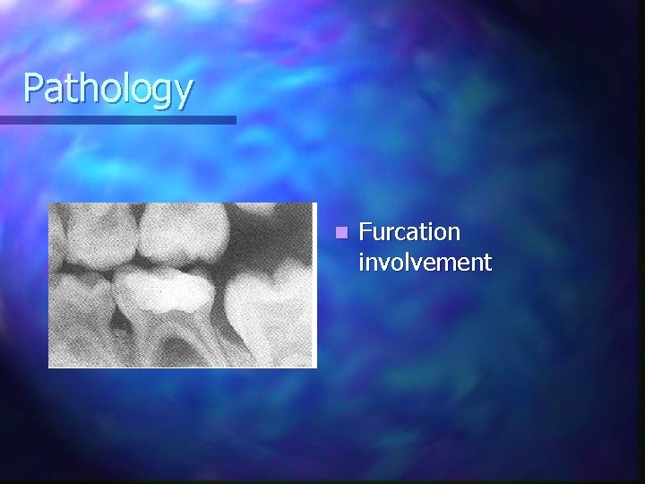 Pathology n Furcation involvement 