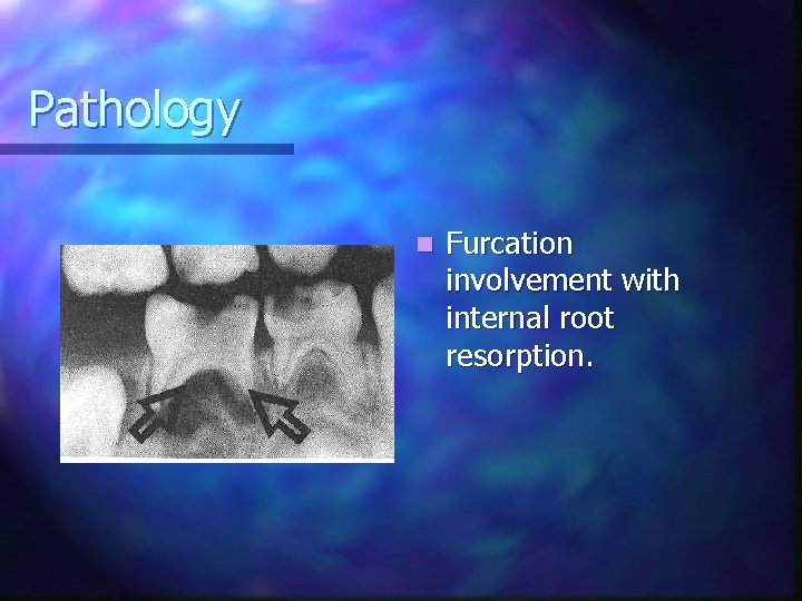 Pathology n Furcation involvement with internal root resorption. 