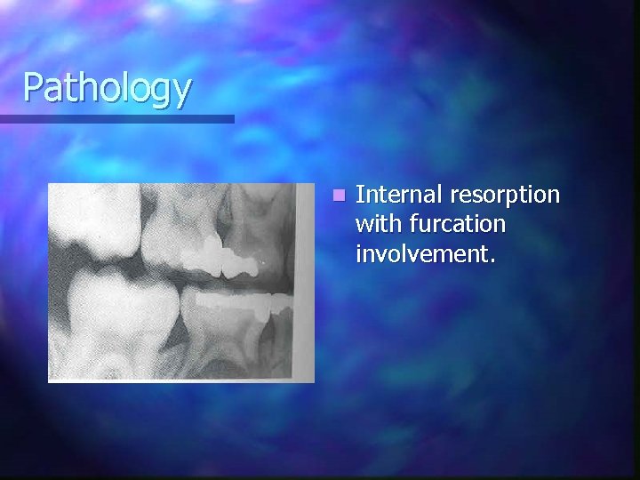 Pathology n Internal resorption with furcation involvement. 