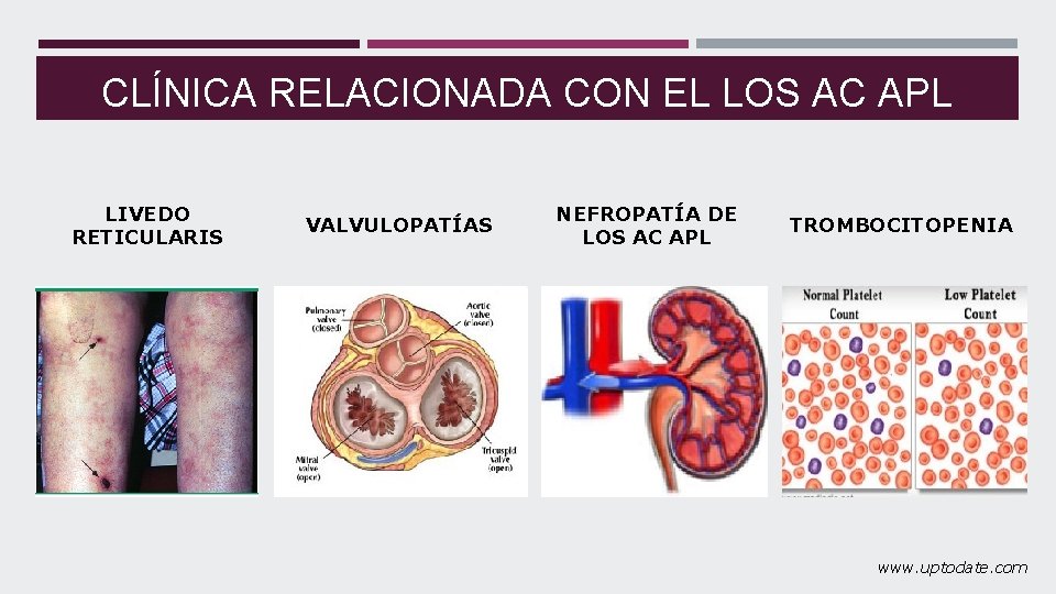 CLÍNICA RELACIONADA CON EL LOS AC APL LIVEDO RETICULARIS VALVULOPATÍAS NEFROPATÍA DE LOS AC