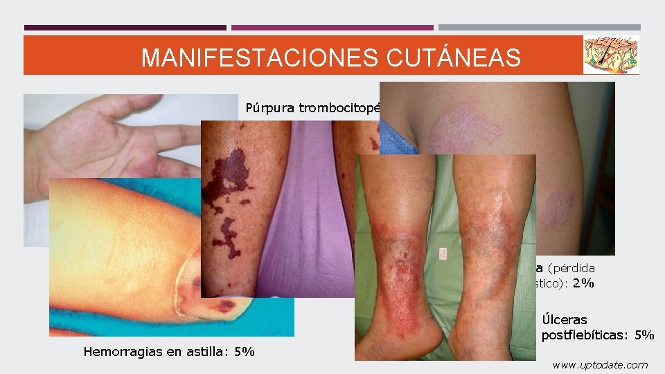 MANIFESTACIONES CUTÁNEAS Púrpura trombocitopénica: 4% Necrosis digital: 8% Anetodermia (pérdida de tejido elástico): 2%