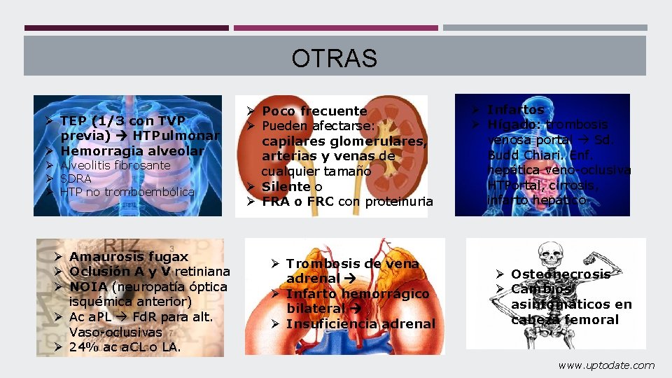 OTRAS Ø TEP (1/3 con TVP previa) HTPulmonar Ø Hemorragia alveolar Ø Alveolitis fibrosante