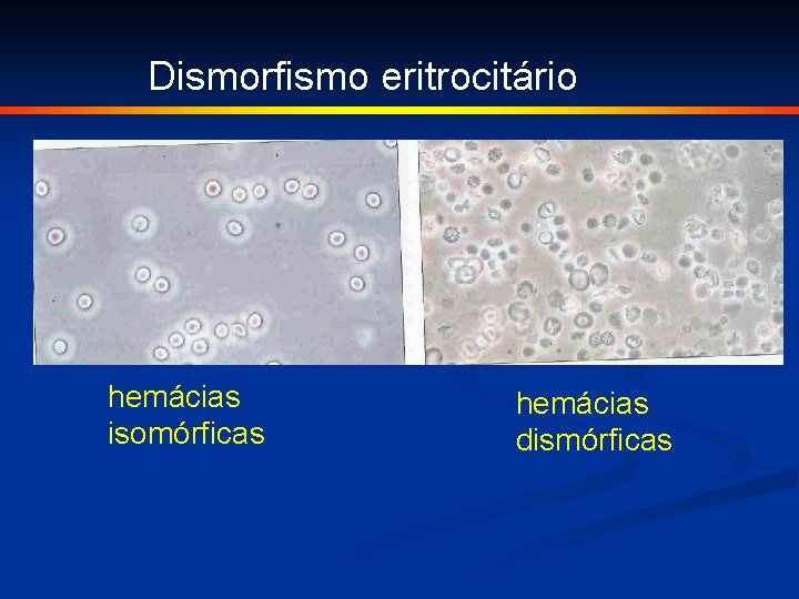 Dismorfismo eritrocitário hemácias isomórficas hemácias dismórficas 