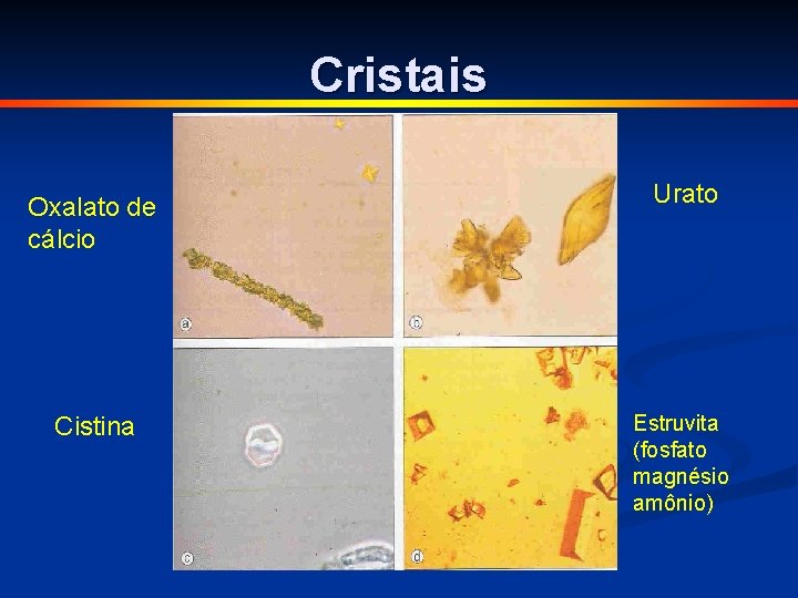 Cristais Oxalato de cálcio Cistina Urato Estruvita (fosfato magnésio amônio) 