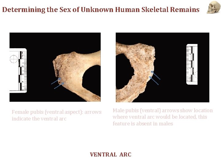 Determining the Sex of Unknown Human Skeletal Remains Female pubis (ventral aspect): arrows indicate