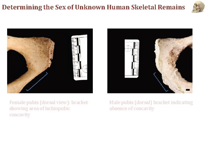 Determining the Sex of Unknown Human Skeletal Remains Female pubis (dorsal view): bracket showing