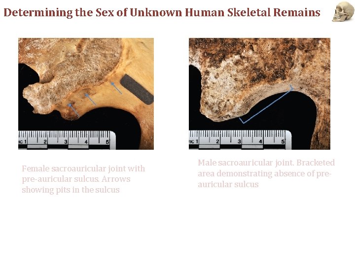 Determining the Sex of Unknown Human Skeletal Remains Female sacroauricular joint with pre-auricular sulcus.