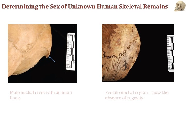 Determining the Sex of Unknown Human Skeletal Remains Male nuchal crest with an inion