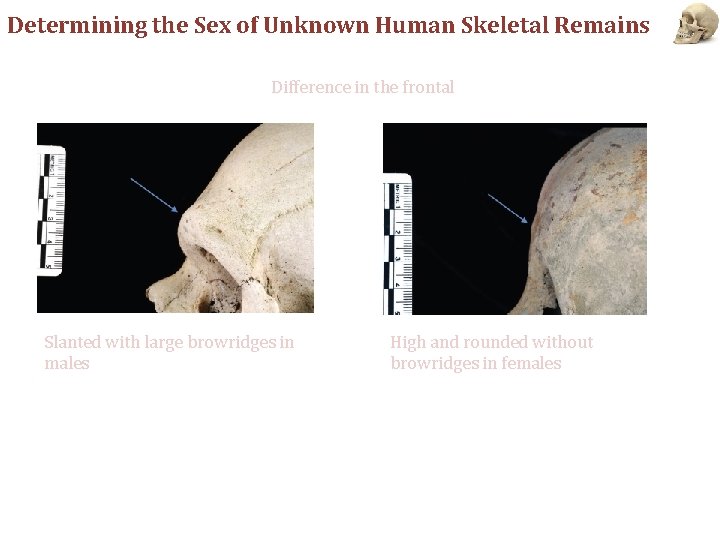 Determining the Sex of Unknown Human Skeletal Remains Difference in the frontal Slanted with