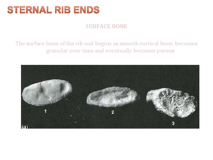 STERNAL RIB ENDS SURFACE BONE The surface bone of the rib end begins as