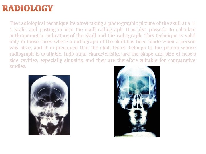 RADIOLOGY The radiological technique involves taking a photographic picture of the skull at a