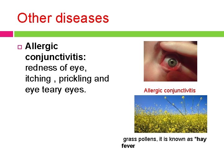 Other diseases Allergic conjunctivitis: redness of eye, itching , prickling and eye teary eyes.