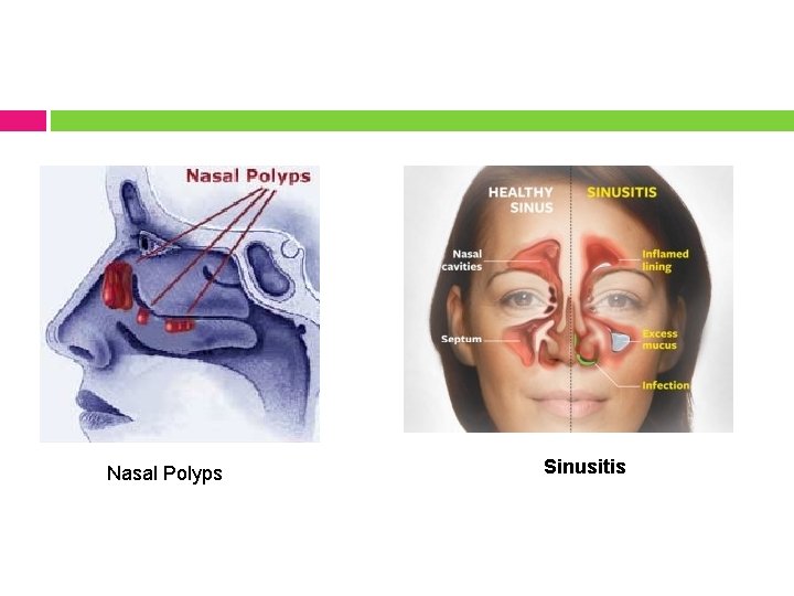 Nasal Polyps Sinusitis 