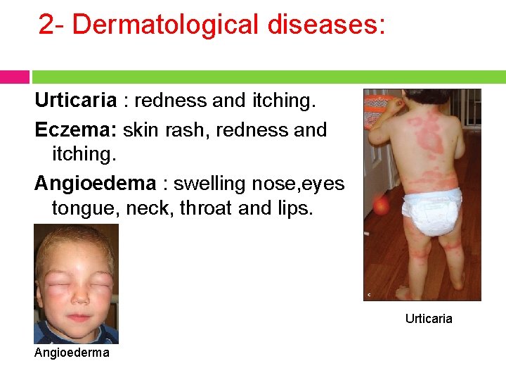 2 - Dermatological diseases: Urticaria : redness and itching. Eczema: skin rash, redness and