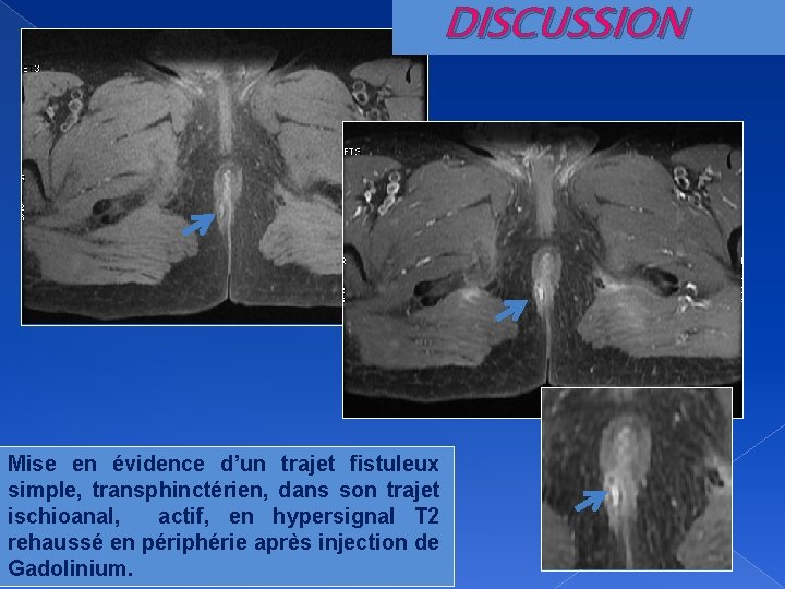 DISCUSSION Mise en évidence d’un trajet fistuleux simple, transphinctérien, dans son trajet ischioanal, actif,