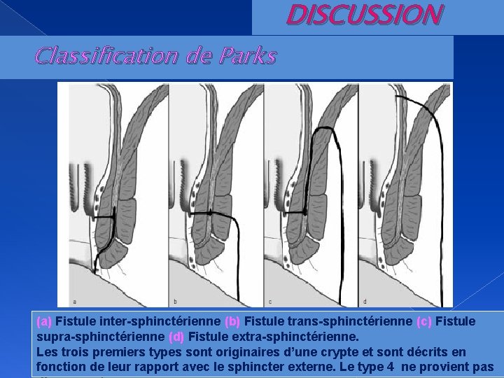 Classification de Parks DISCUSSION (a) Fistule inter-sphinctérienne (b) Fistule trans-sphinctérienne (c) Fistule supra-sphinctérienne (d)