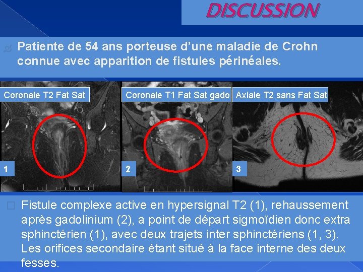 DISCUSSION Patiente de 54 ans porteuse d’une maladie de Crohn connue avec apparition de