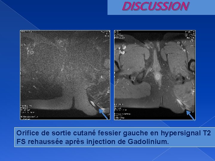 DISCUSSION Orifice de sortie cutané fessier gauche en hypersignal T 2 FS rehaussée après