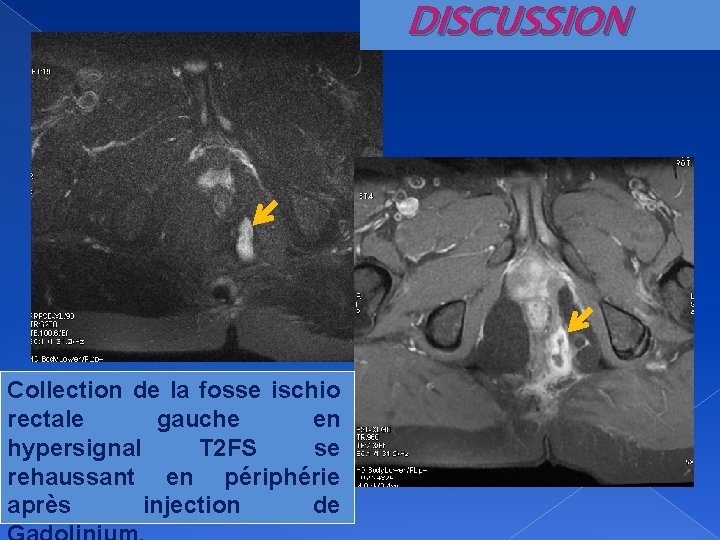 DISCUSSION Collection de la fosse ischio rectale gauche en hypersignal T 2 FS se