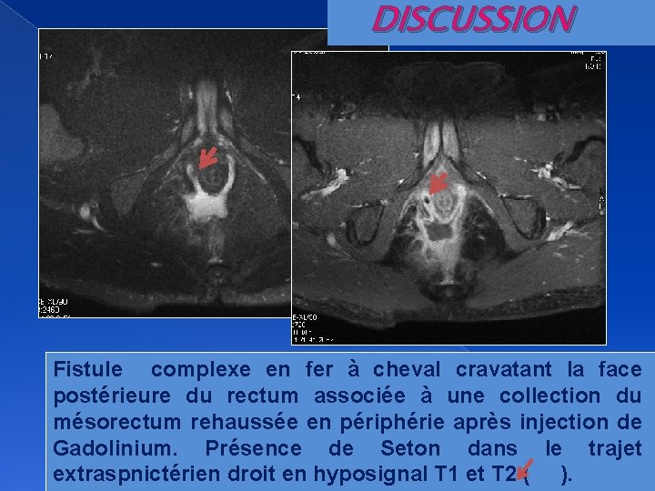 DISCUSSION Fistule complexe en fer à cheval cravatant la face postérieure du rectum associée