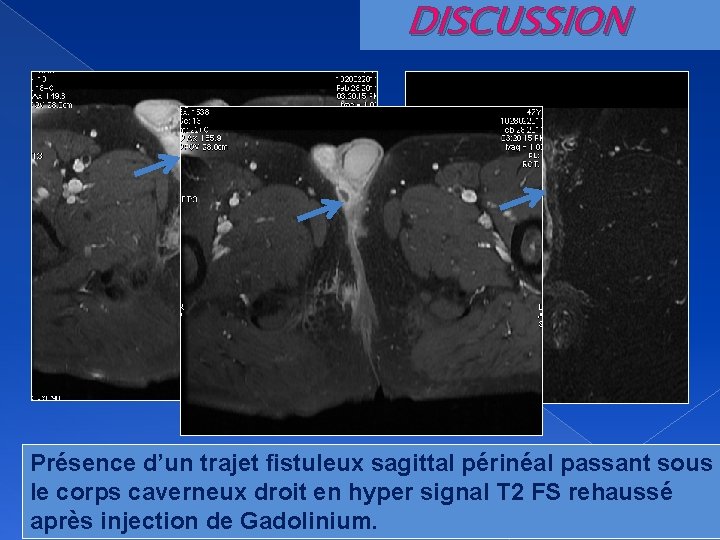 DISCUSSION Présence d’un trajet fistuleux sagittal périnéal passant sous le corps caverneux droit en