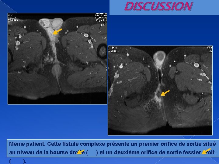 DISCUSSION Même patient. Cette fistule complexe présente un premier orifice de sortie situé au