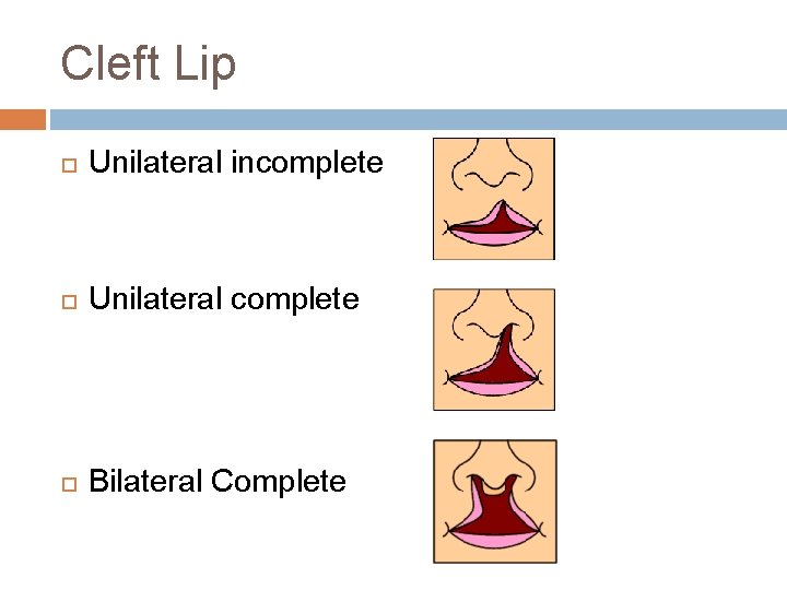 Cleft Lip Unilateral incomplete Unilateral complete Bilateral Complete 