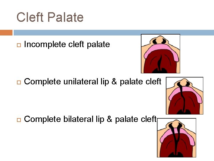 Cleft Palate Incomplete cleft palate Complete unilateral lip & palate cleft Complete bilateral lip