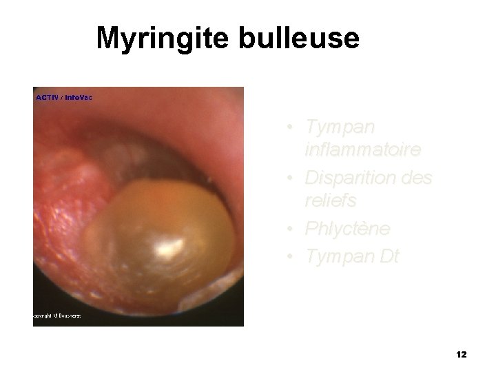 Myringite bulleuse • Tympan inflammatoire • Disparition des reliefs • Phlyctène • Tympan Dt