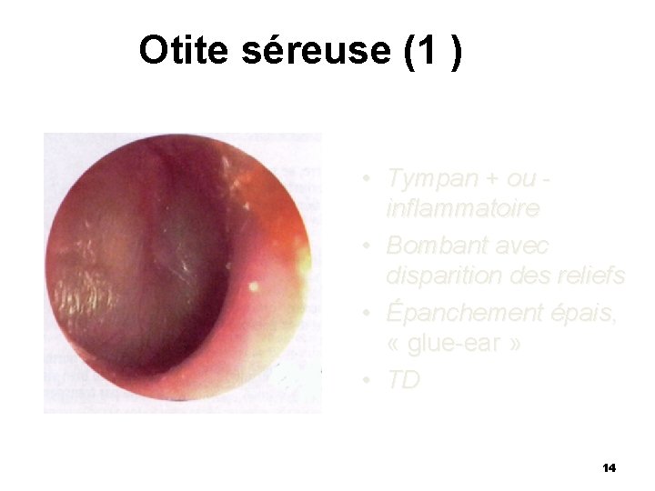 Otite séreuse (1 ) • Tympan + ou inflammatoire • Bombant avec disparition des Otite séreuse (1 ) • Tympan + ou inflammatoire • Bombant avec disparition des