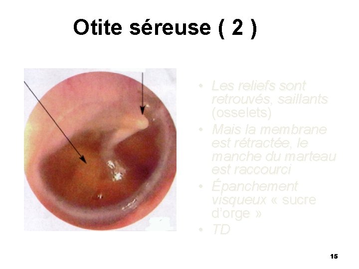 Otite séreuse ( 2 ) • Les reliefs sont retrouvés, saillants (osselets) • Mais